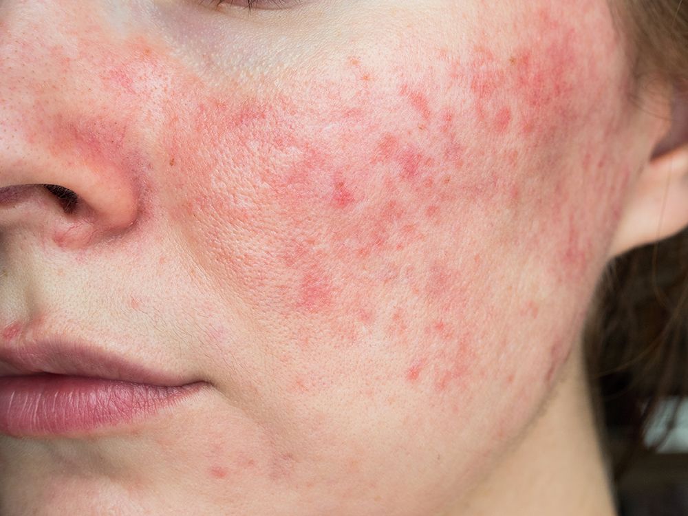SENSITIVE AND REDNESS