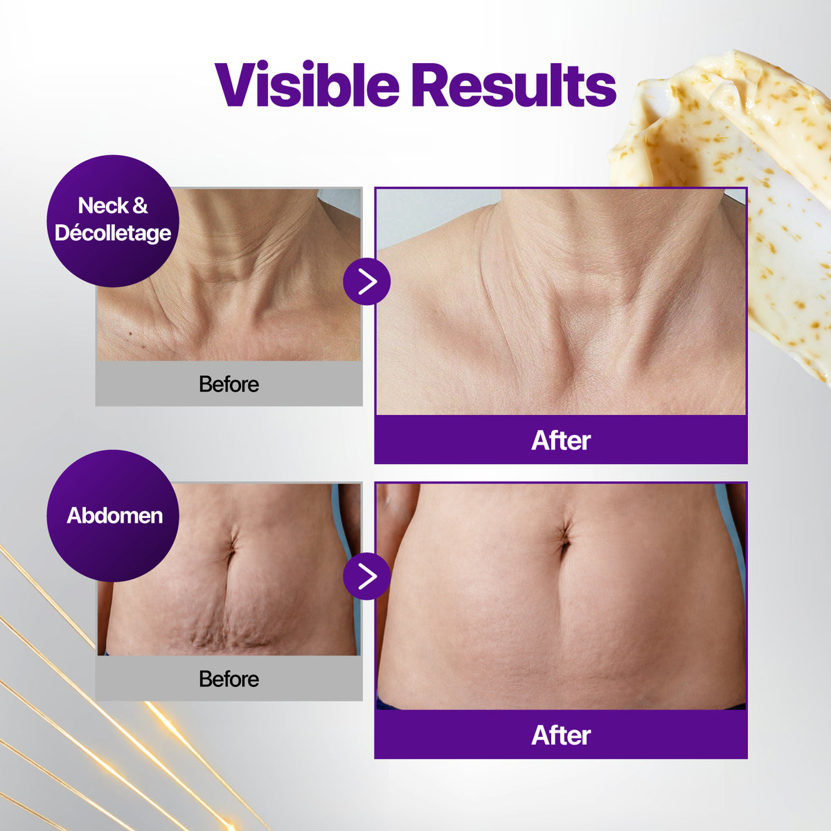 Before-and-after comparison graphic showing visible skin tightening results on a neck and abdomen, with purple text and labels on a light gray background.